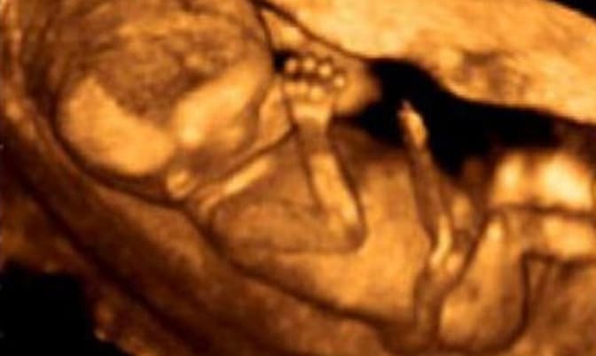 Ultrasound